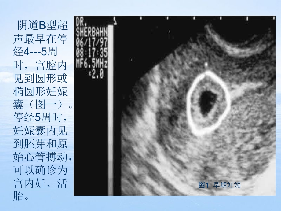 《妊娠滋养细胞疾病》PPT课件.ppt_第2页