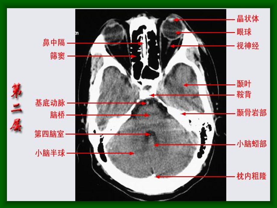 《头颅ct解剖》PPT课件.ppt_第2页