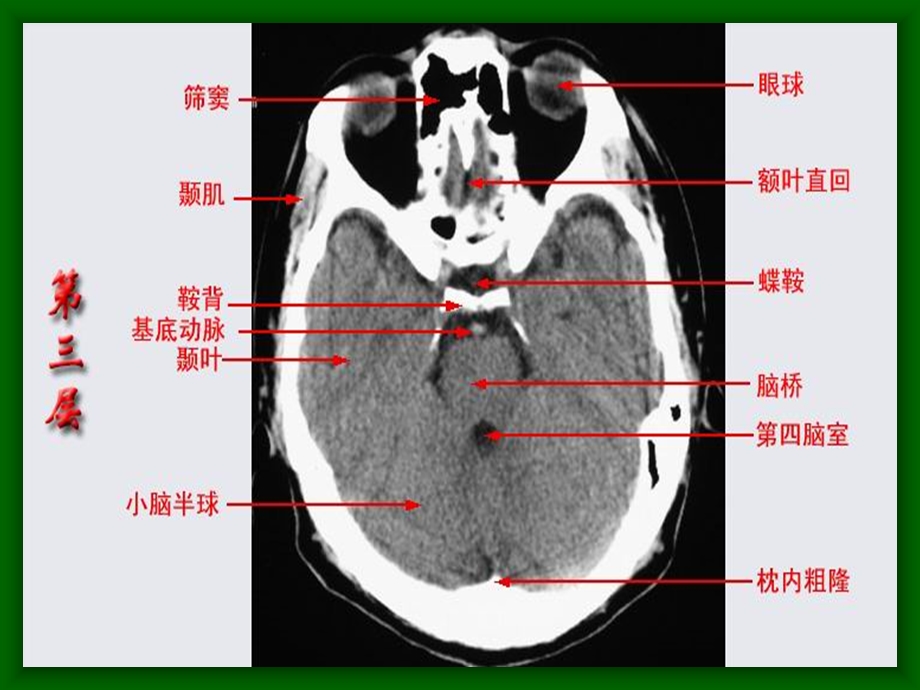 《头颅ct解剖》PPT课件.ppt_第3页