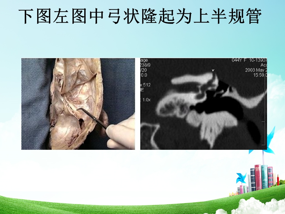 上半规管裂综合征.ppt_第3页