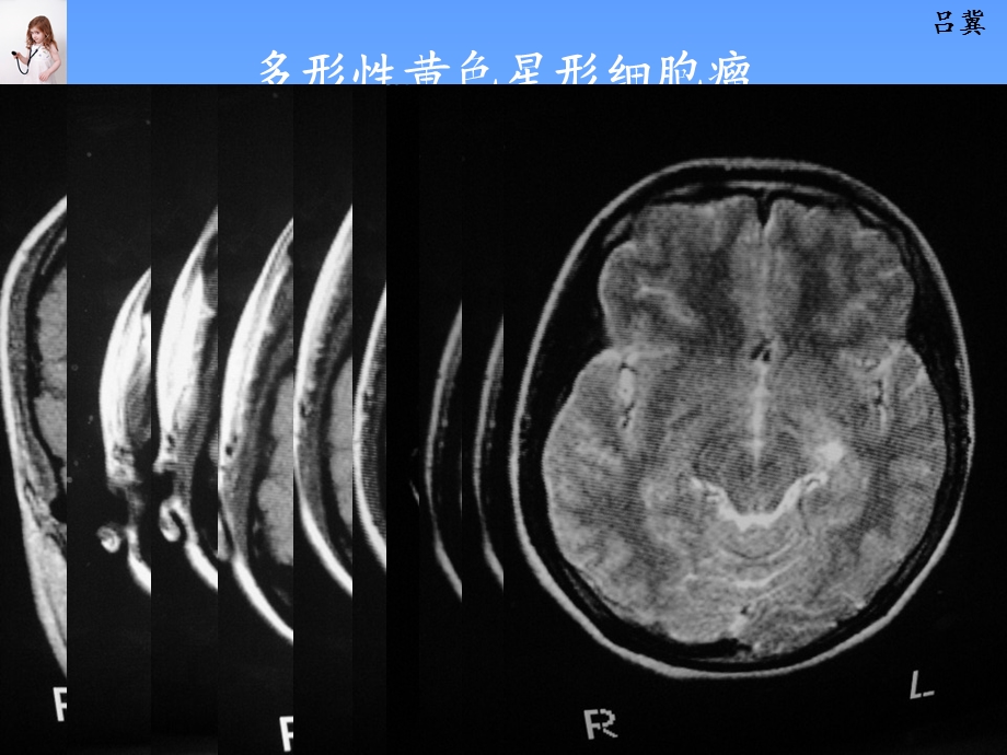 医影在线CNS疾病MRI诊断(6).ppt_第2页