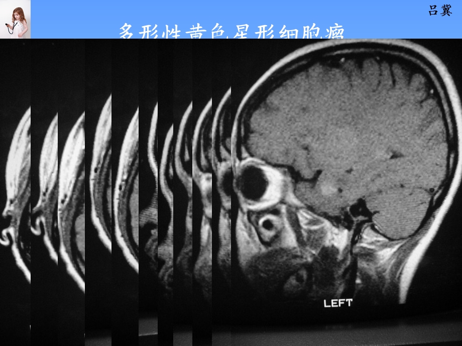 医影在线CNS疾病MRI诊断(6).ppt_第3页