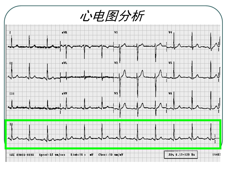 《异常心电》PPT课件.ppt_第2页