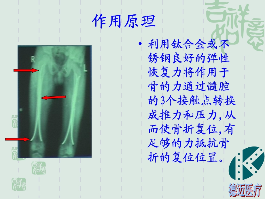 《弹性髓内钉》PPT课件.ppt_第3页