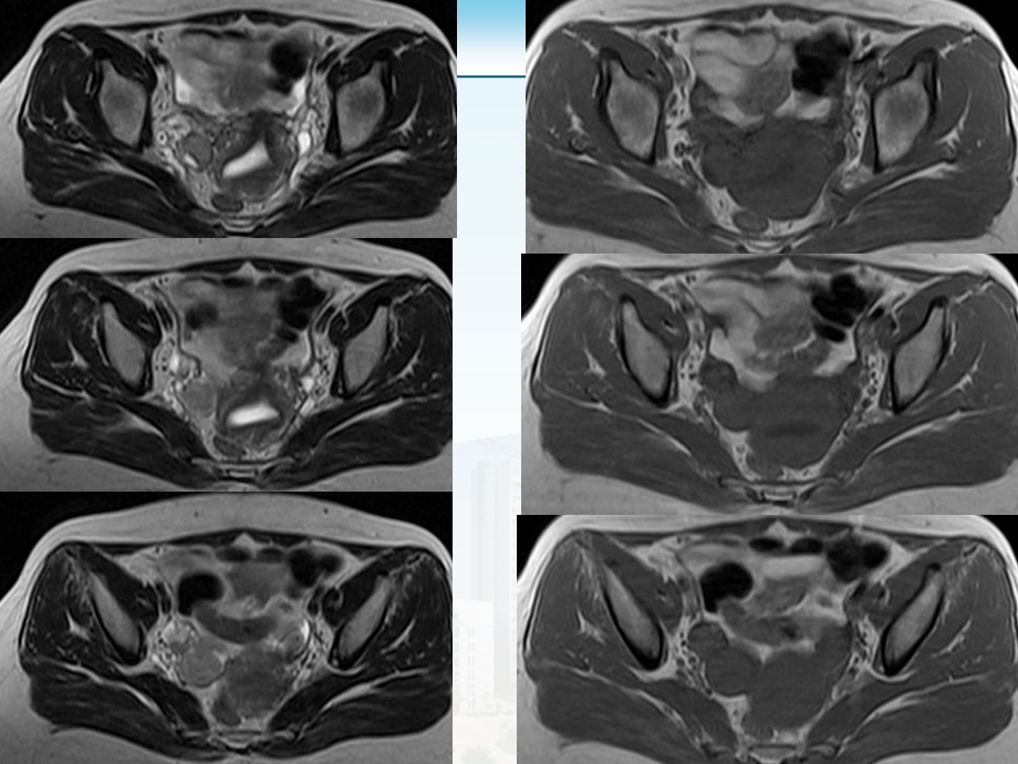盆腔病例读片东莞市石龙人民医院放射科.ppt_第3页