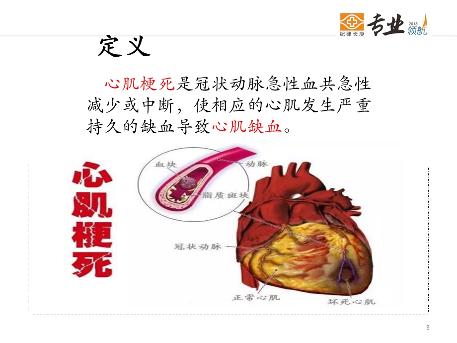 《心肌梗死的护理》PPT课件.ppt_第3页