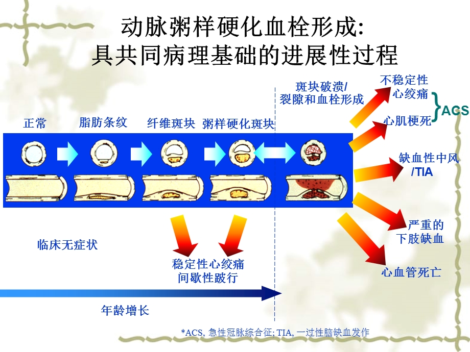 《不稳定心绞痛》PPT课件.ppt_第2页