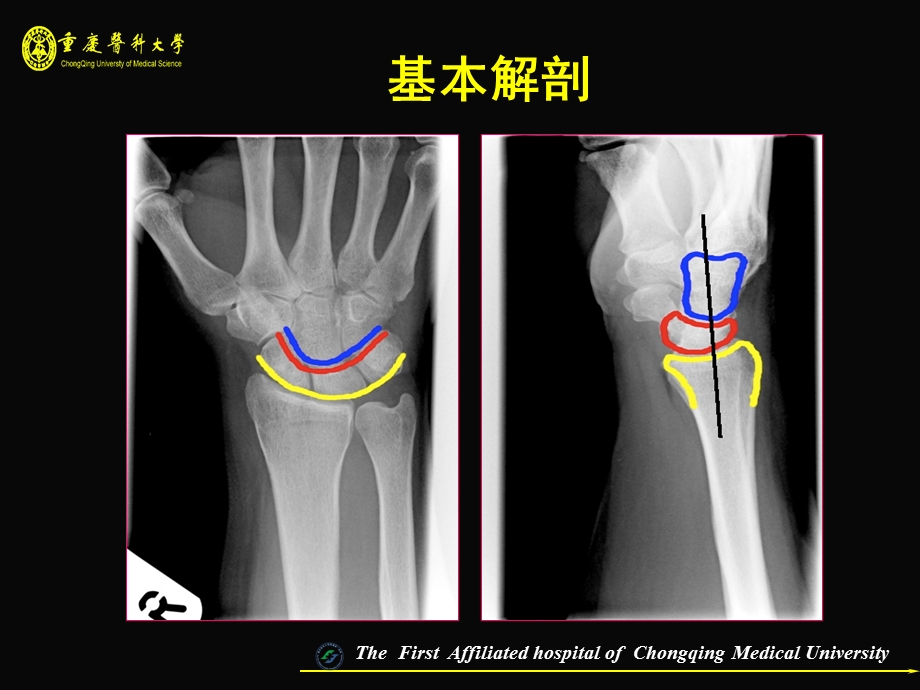 腕关节损伤MRI.ppt_第2页