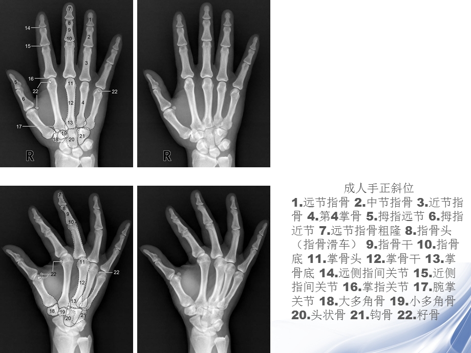 医学影像四肢关节正常变异、常见病变及创伤的影像表现.ppt_第3页