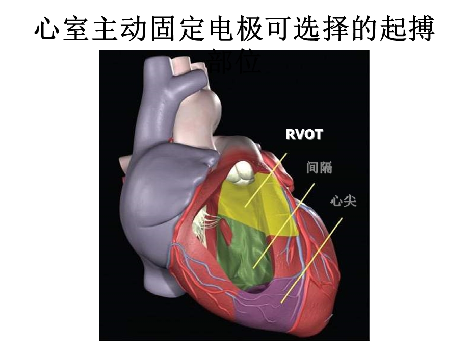 如何保证高位室间隔起搏.ppt_第3页