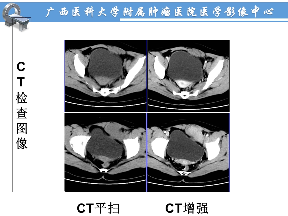 《侵袭性纤维瘤病》PPT课件.ppt_第3页