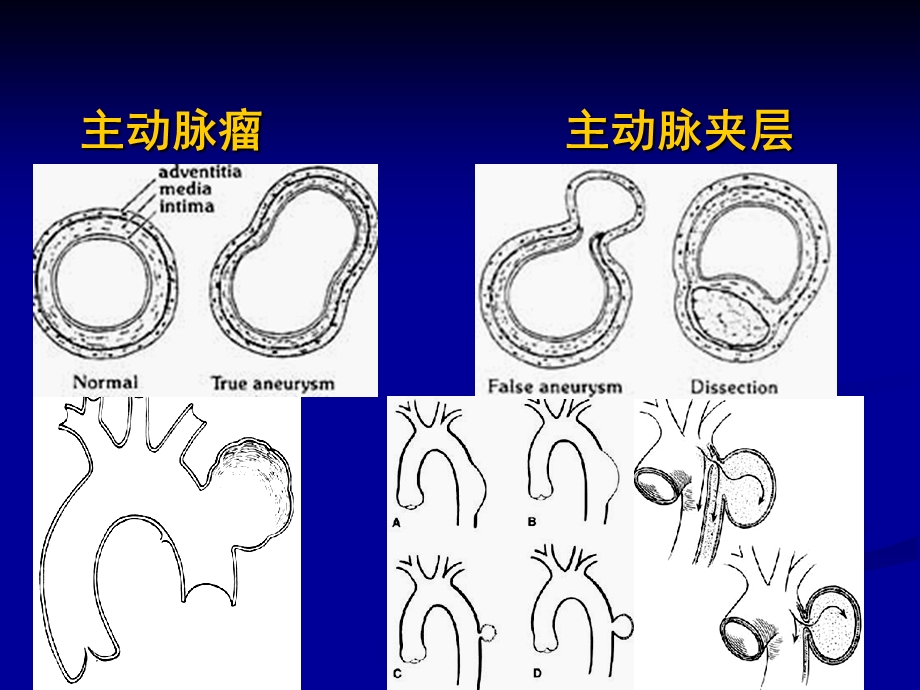 《大血管疾病》PPT课件.ppt_第3页