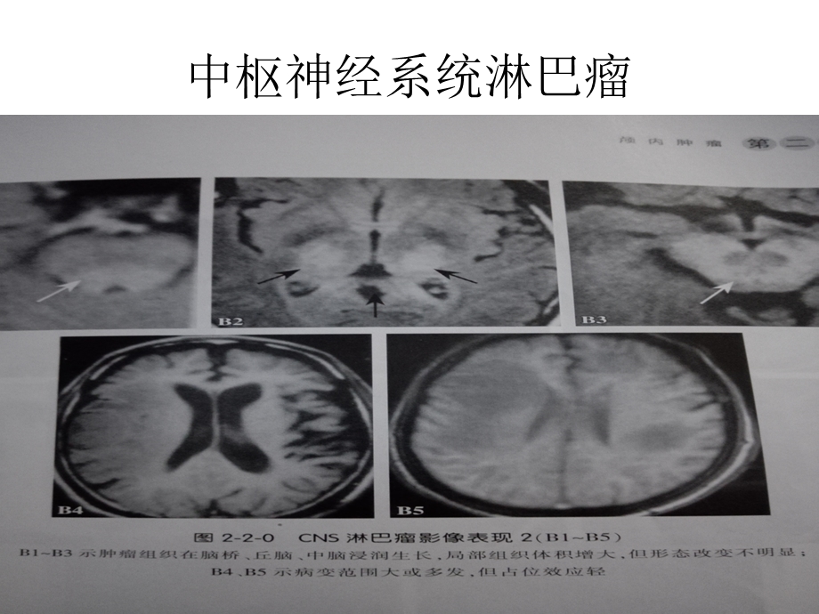 神经系统疾病图片.ppt_第3页