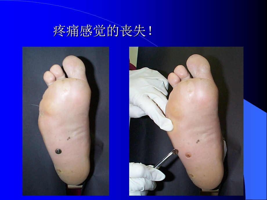 糖尿病足讲座4.ppt_第3页