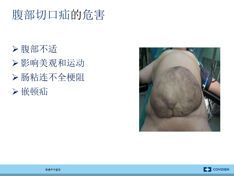 《腹壁疝的治疗》PPT课件.ppt_第3页