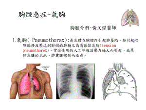 《胸腔急症气胸》PPT课件.ppt