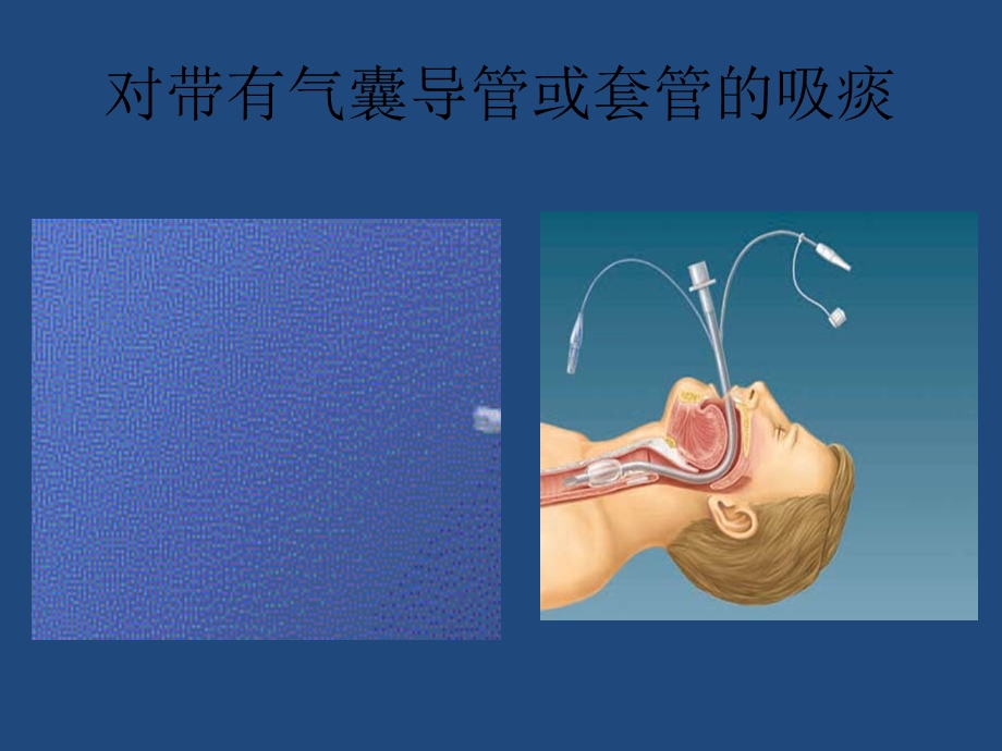 《气管切开吸痰》PPT课件.ppt_第3页