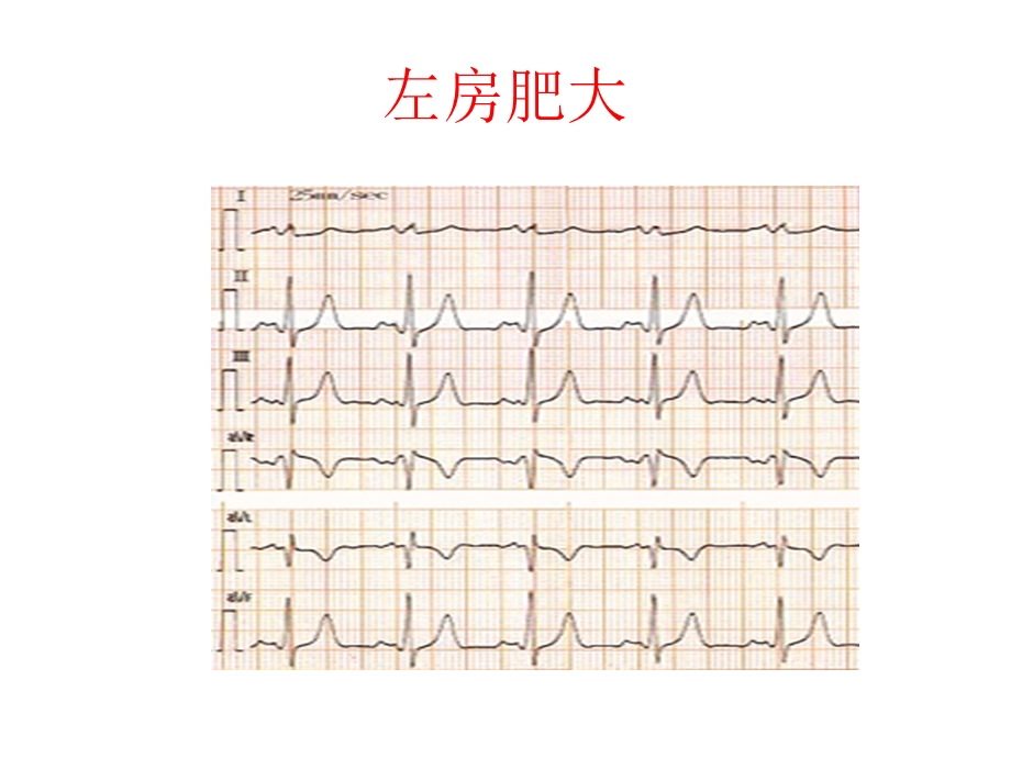 心电图 肥大.ppt_第3页