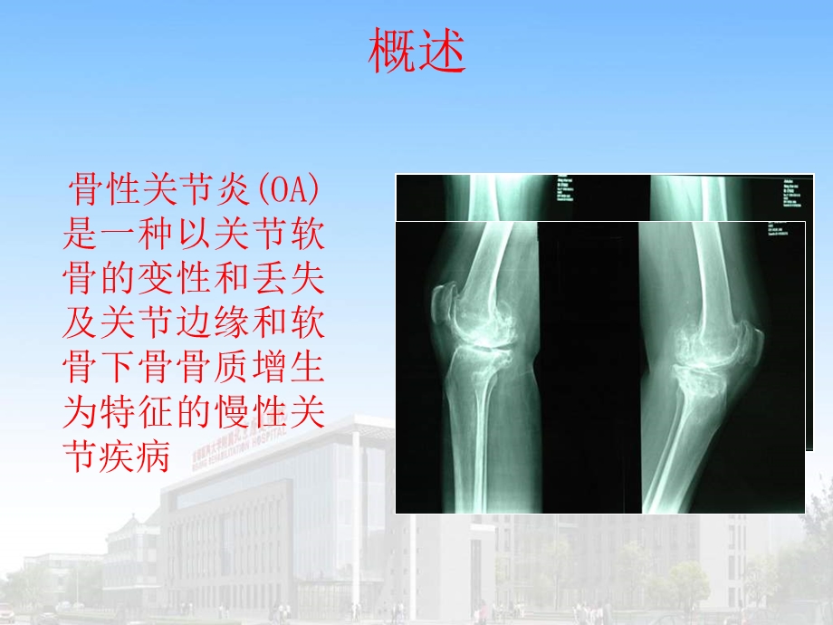 膝关单髁置换.ppt_第2页