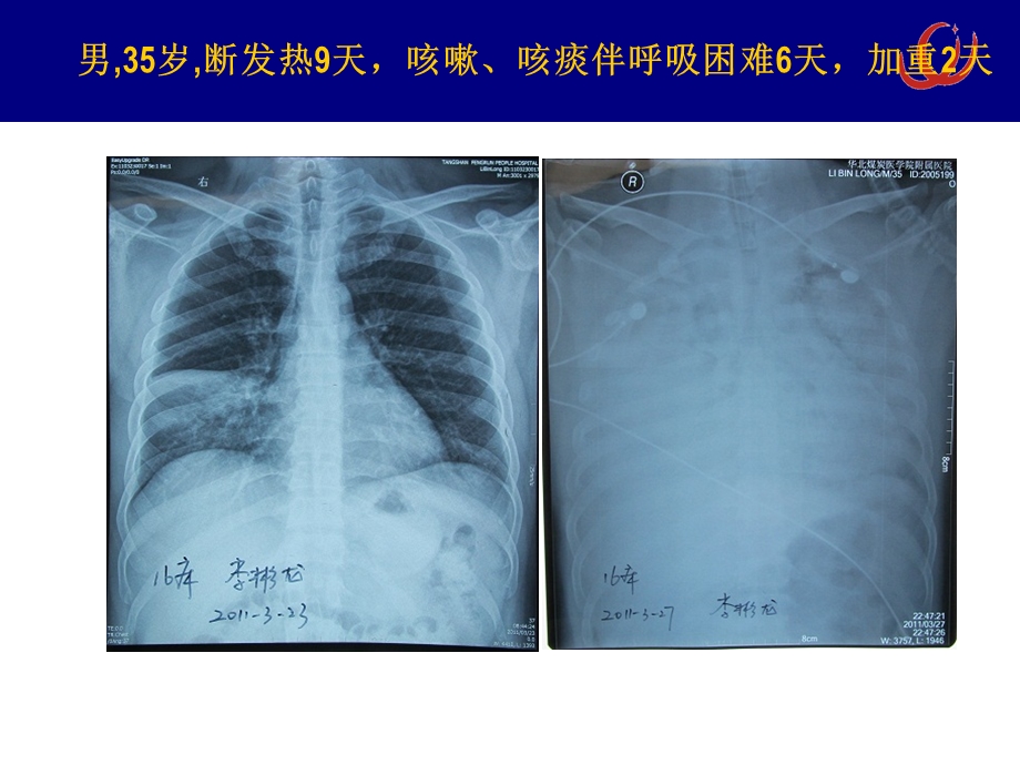 《ECMO的安全性》PPT课件.ppt_第3页