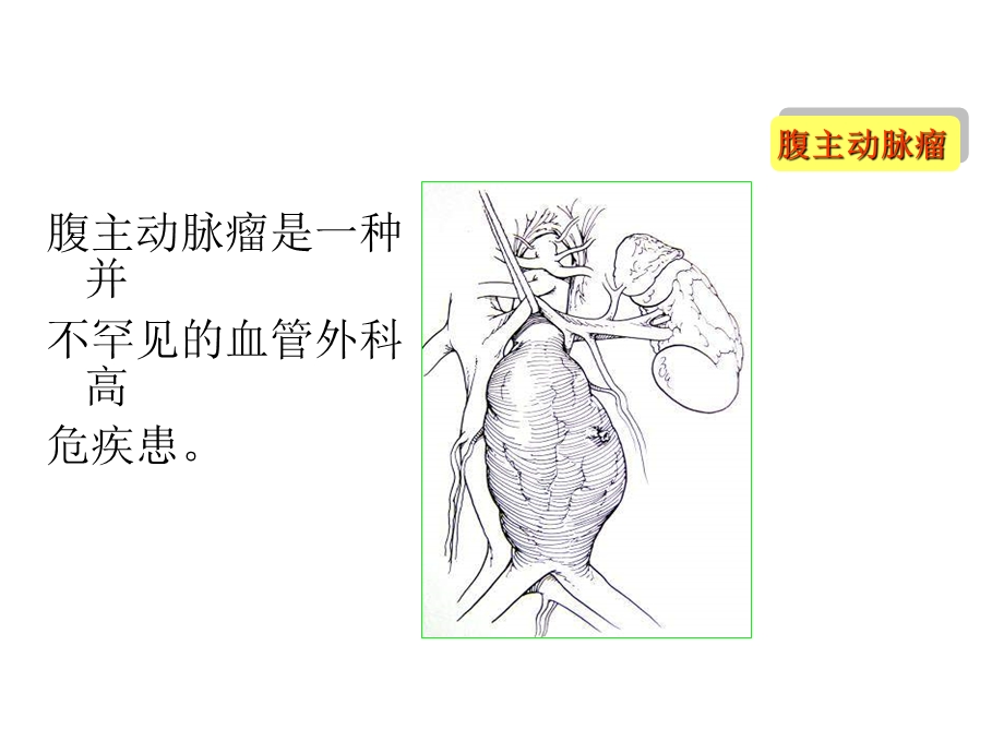 《腹主动脉瘤》PPT课件.ppt_第2页