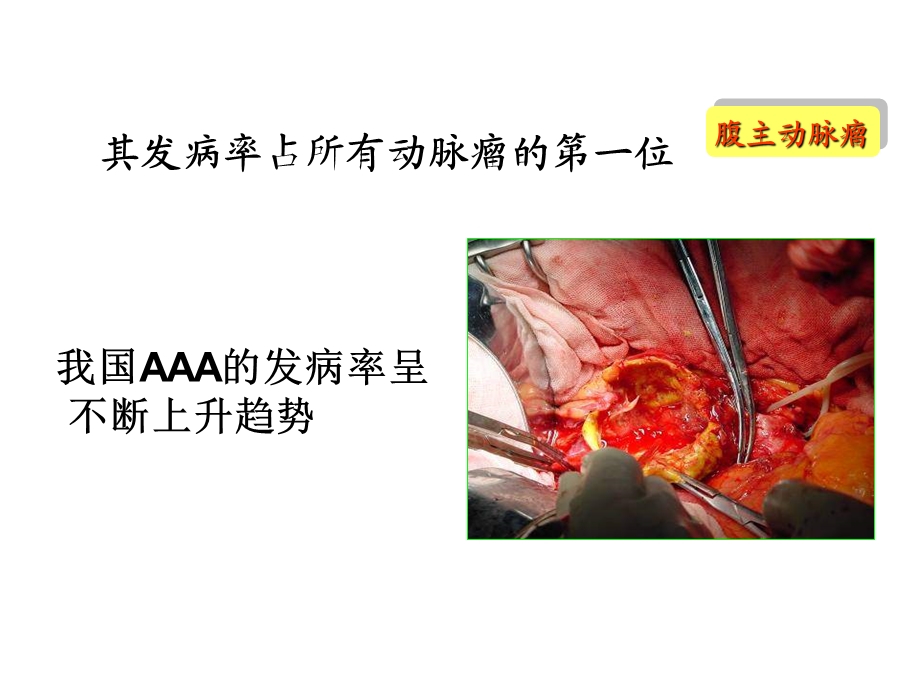 《腹主动脉瘤》PPT课件.ppt_第3页