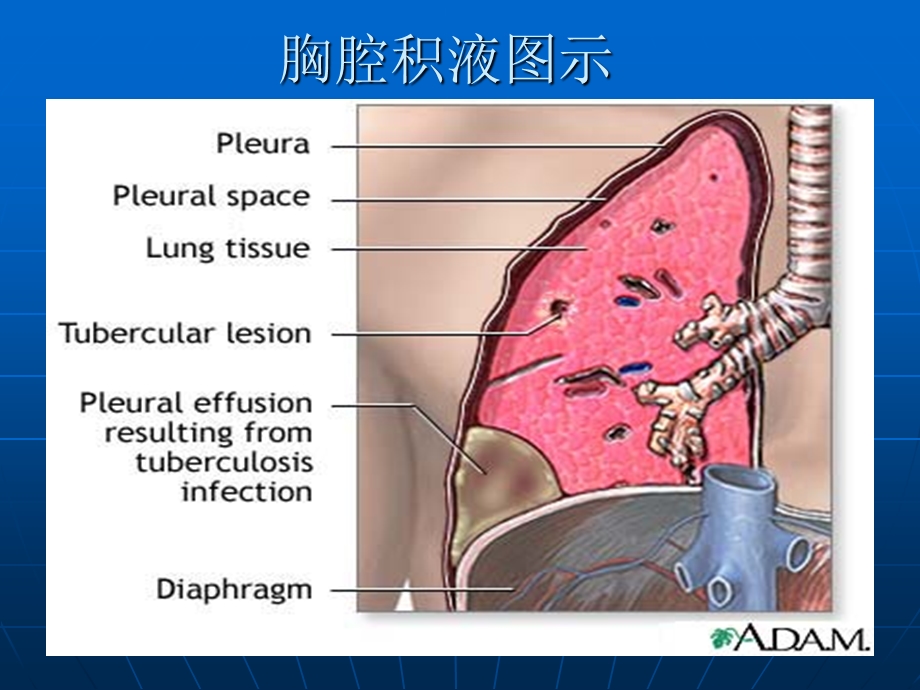 《胸膜腔穿刺术》PPT课件.ppt_第3页