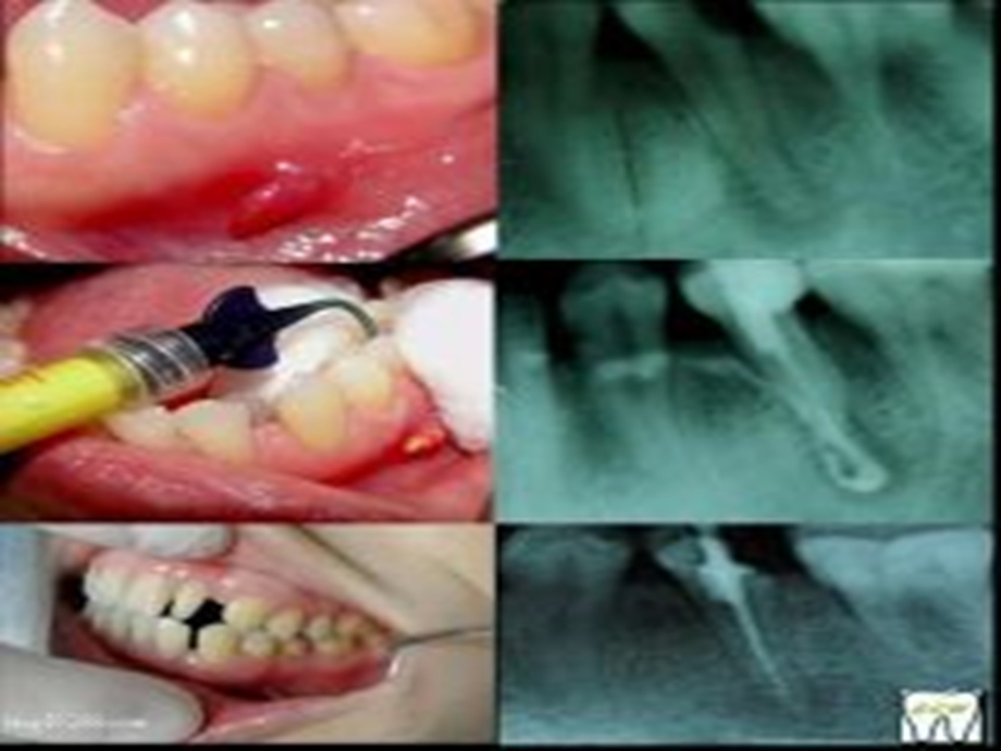 《根尖周病》PPT课件.ppt_第3页