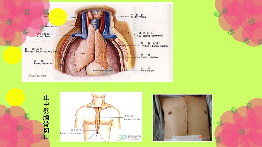 《胸腺瘤护理查房》PPT课件.ppt_第3页