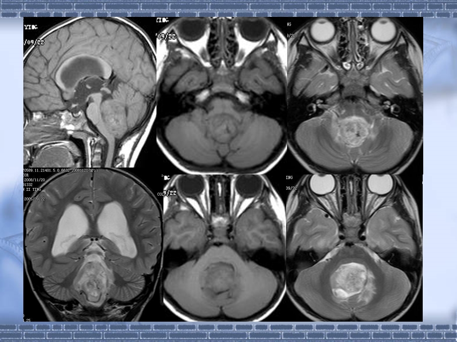 小儿头颅核磁.ppt_第2页