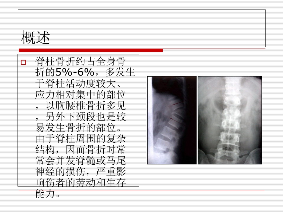 《脊柱骨折康复》PPT课件.ppt_第3页