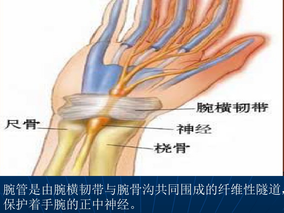 《腕管综合征护理》PPT课件.ppt_第3页