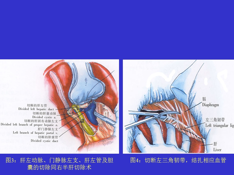 左半肝切除术1.ppt_第2页