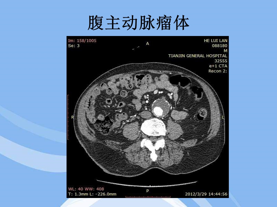 输入道闭塞扭曲的腹主动脉瘤合并髂动脉多发动脉瘤一例.ppt_第2页