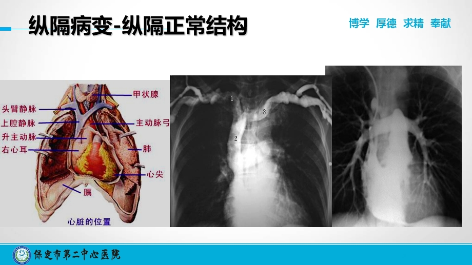 《胸片读片技巧下》PPT课件.ppt_第3页