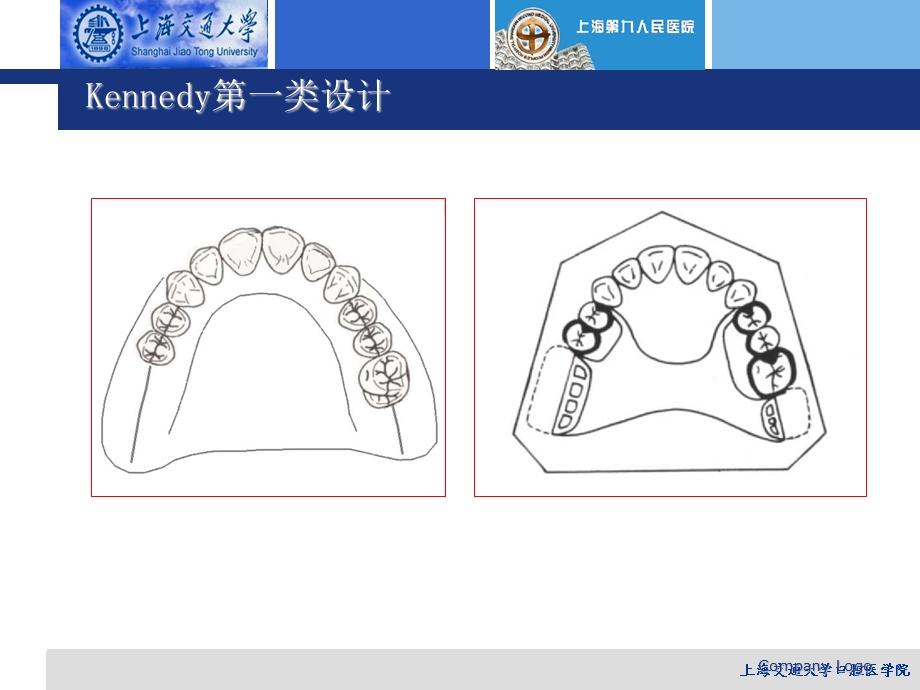 《活动义齿设计》PPT课件.ppt_第3页