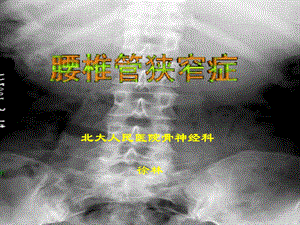 《腰椎管狭窄症》PPT课件.ppt