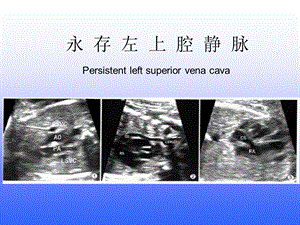 《永存左上腔静脉》PPT课件.ppt