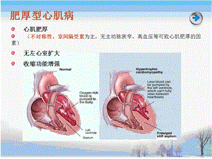 《肥厚型心肌病》PPT课件.ppt