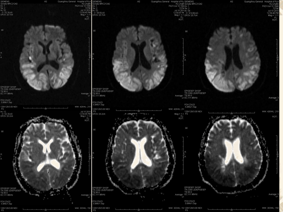 总结DWI在颅脑疾病诊断中的应用 (中).ppt_第2页