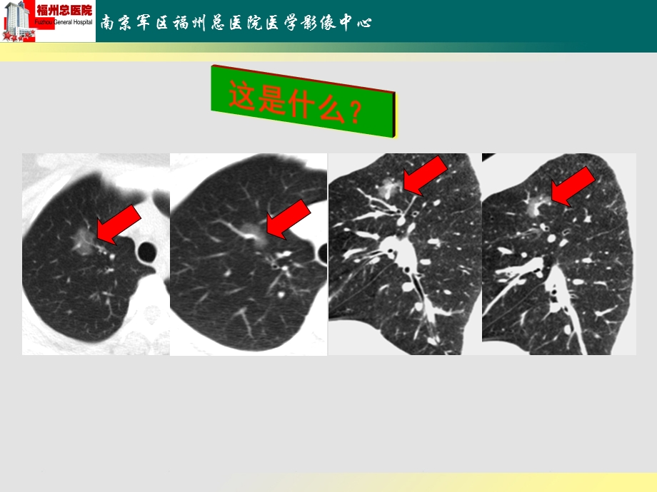 《肺毛玻璃样病变》PPT课件.ppt_第3页