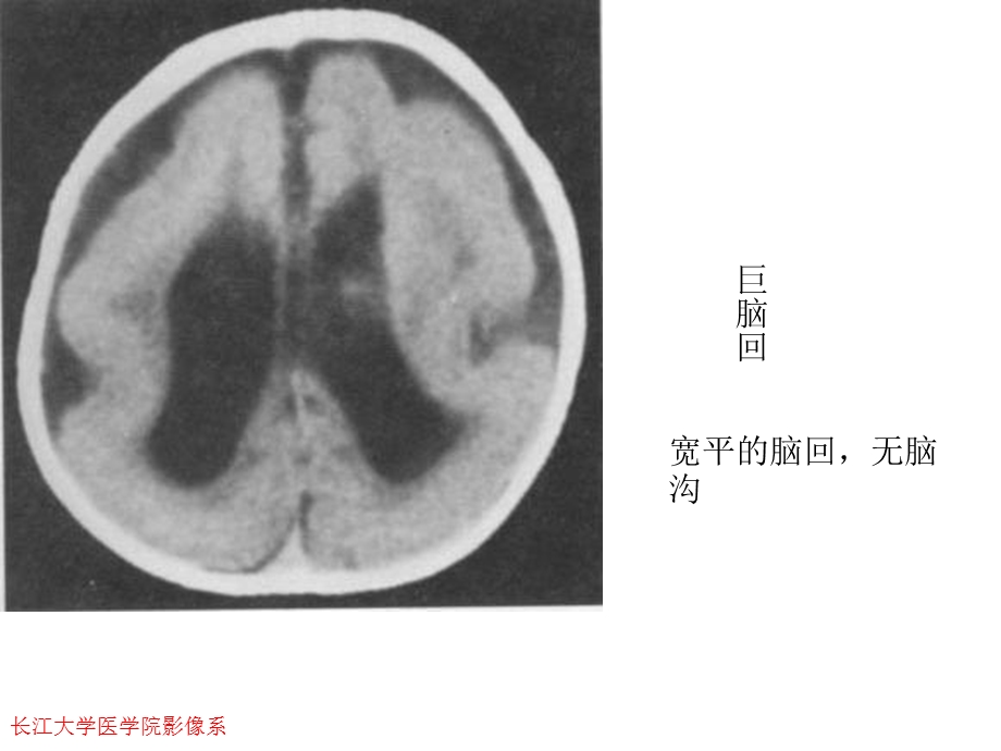 《畸形与脑血管》PPT课件.ppt_第2页