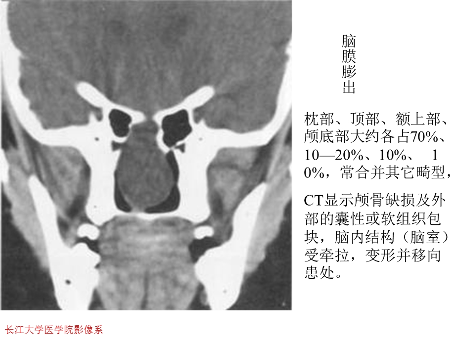 《畸形与脑血管》PPT课件.ppt_第3页