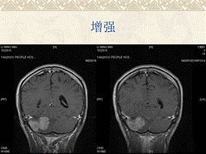 总结DWI在颅脑疾病诊断中的应用 (下).ppt