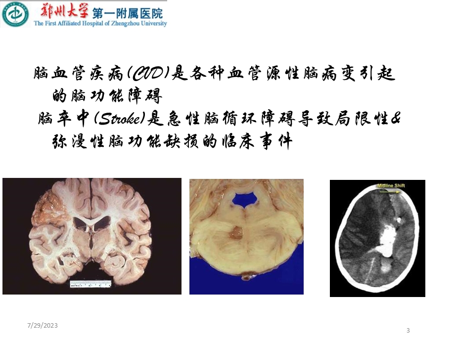 《脑血管病诊治》PPT课件.ppt_第3页