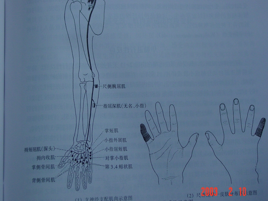 《肘部尺神经卡压》PPT课件.ppt_第3页