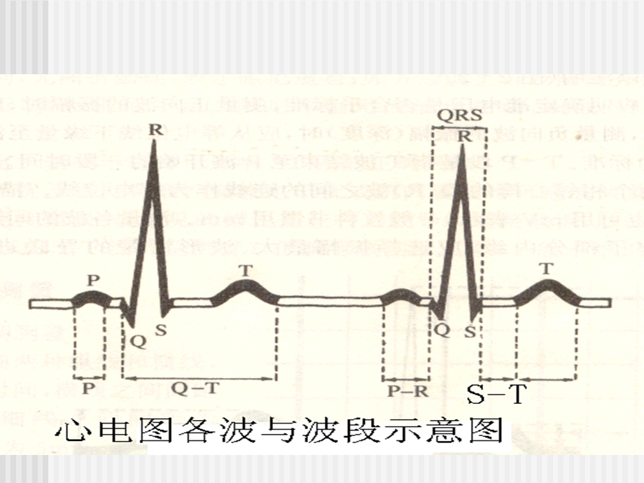 执业医师考试心电图培训真题.ppt_第2页