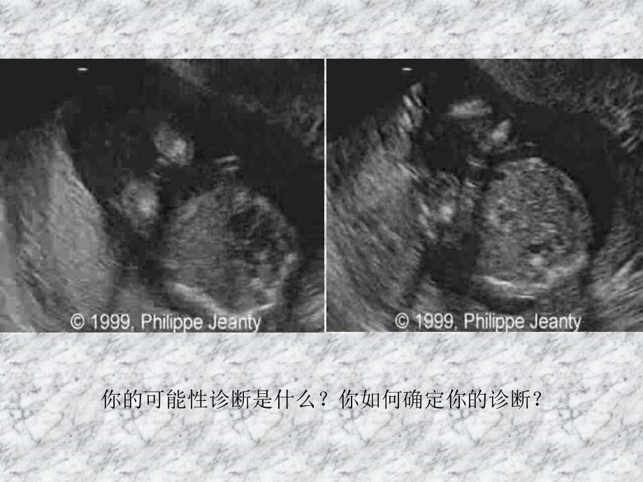 胎儿病例1.ppt_第3页