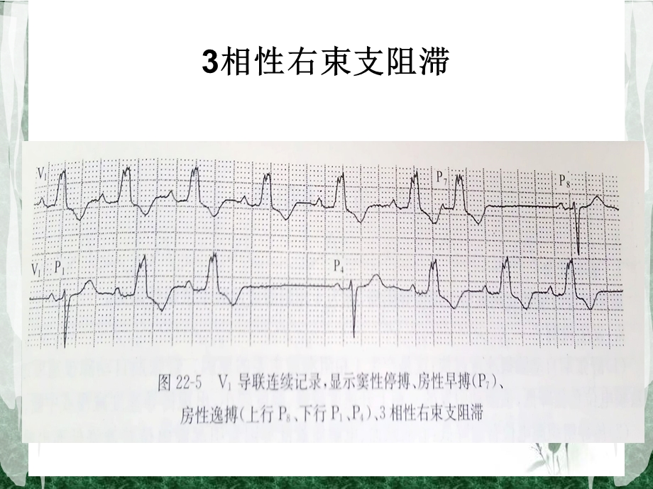 心电图频率依赖性束支传导阻滞.ppt_第3页