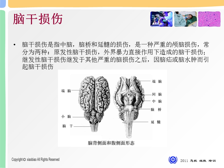 《脑干损伤初探》PPT课件.ppt_第2页